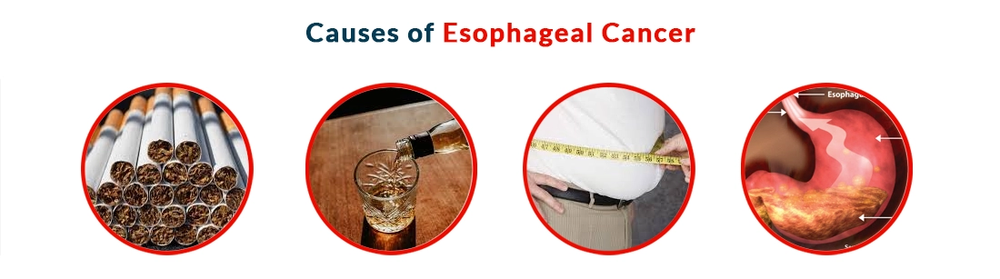 Causes of Esophageal Cancer